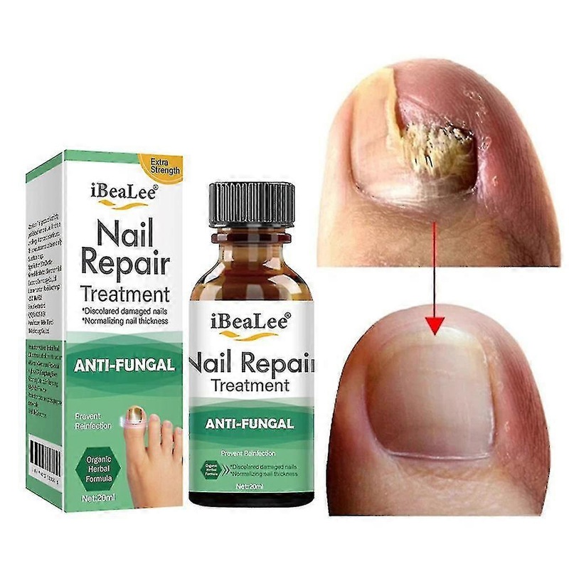 Minglan Foot Fungus Treatment For Toe Nail Foot Antifungal Agent Cuticle Oil Nail Polish Remover Onychomycosis Medicine Foot Care Beauty