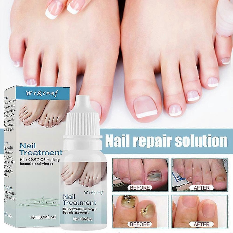 1/2 pcs of fungal nail treatment fluid VERY EFFECTIVE KILLS TOENNAIL FUNGUS